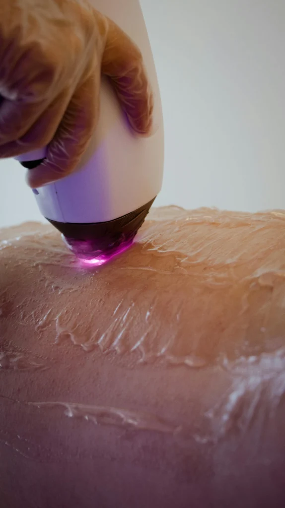 depilacion laser diodo en sevilla