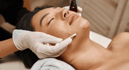 tratamiento antiacne sevilla