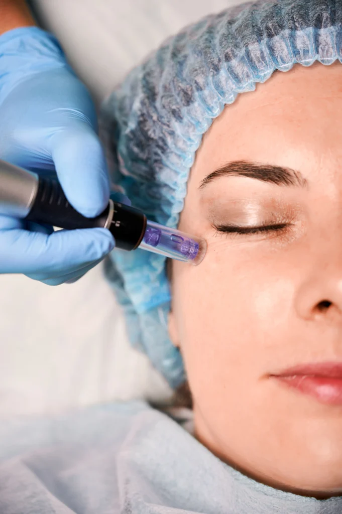 dermapen sevilla