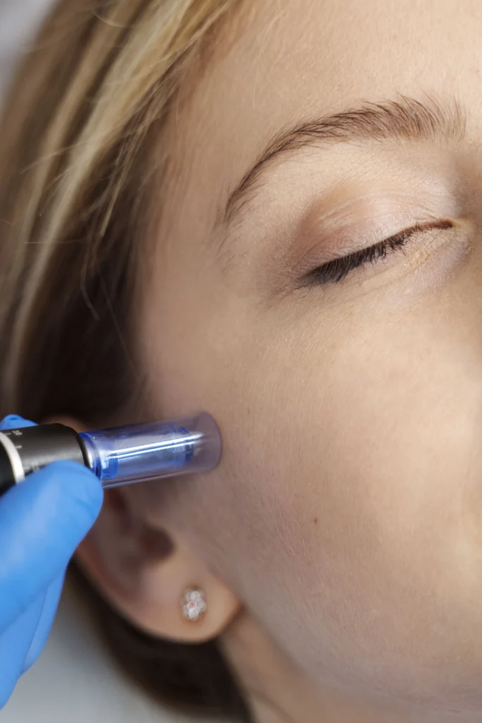 limpieza facial con extraccion sevilla